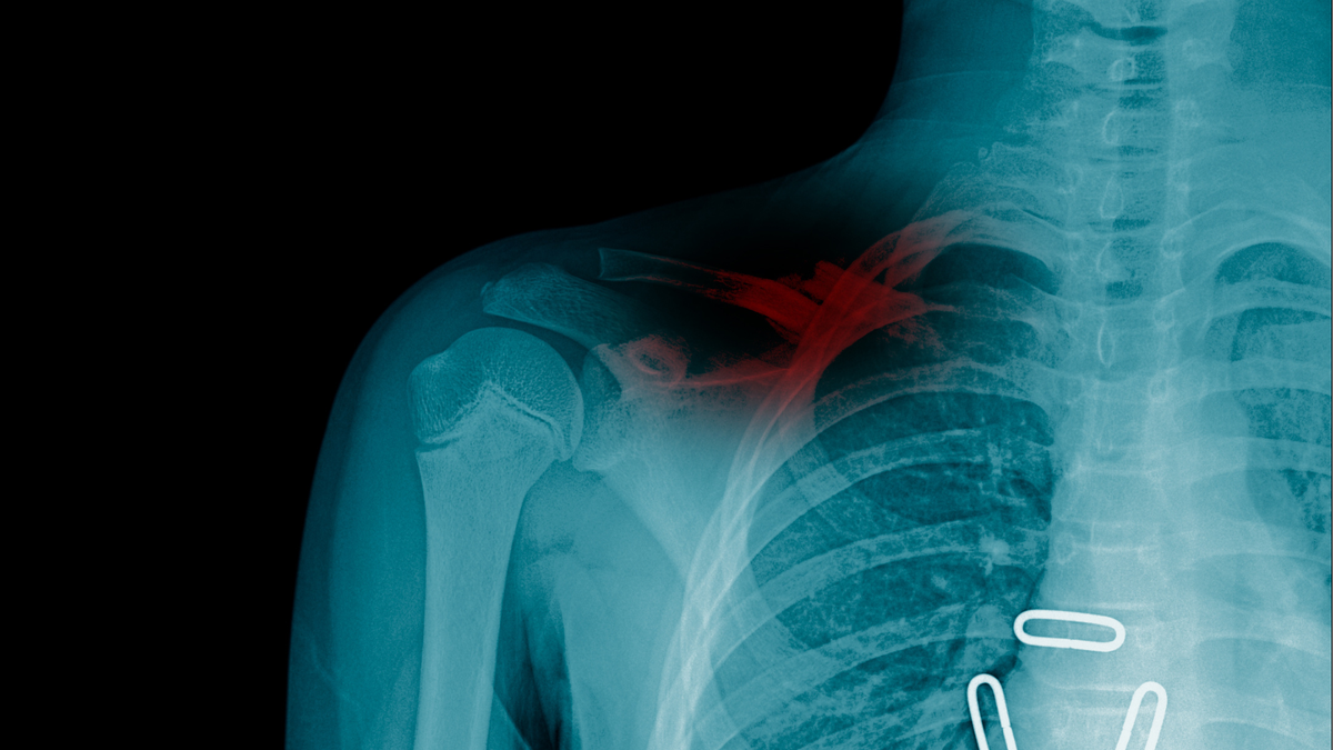 ICYMI: Clavicle Fracture Guideline — Strengths and Soft Spots
