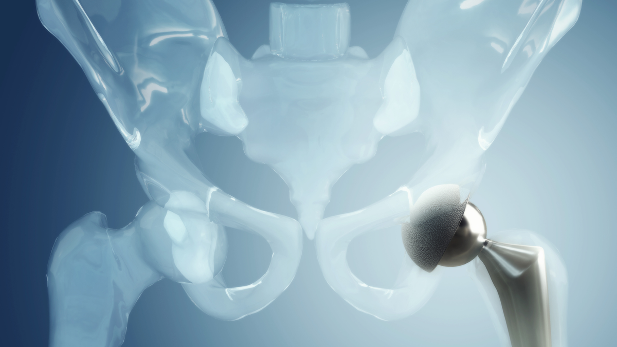 Approach Really Matters in Hemiarthroplasty for Hip Fracture