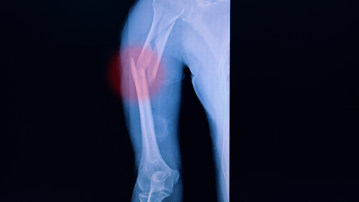 Bracing Versus Surgery for Humeral Shaft Fractures — All Is Not As It Appears