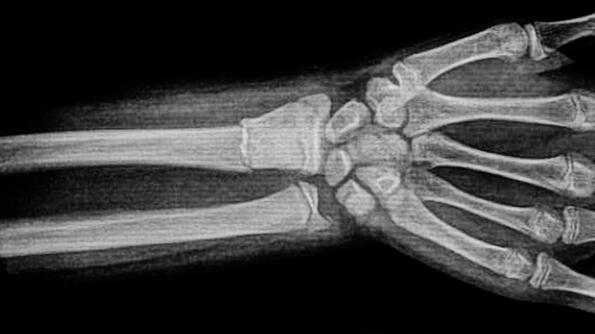 WALANT for Distal Radius Fractures?