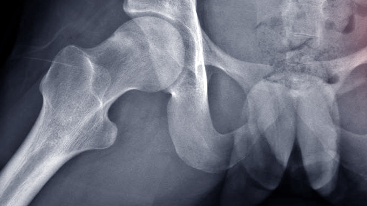 The Importance of Neck-Shaft Angle When Treating Intertrochanteric Hip Fractures