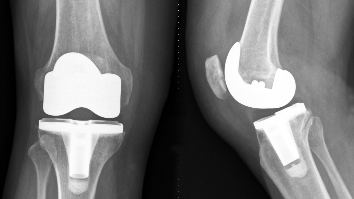 Removal of IM Tibial Nails Before TKA — Staged or Same Day?