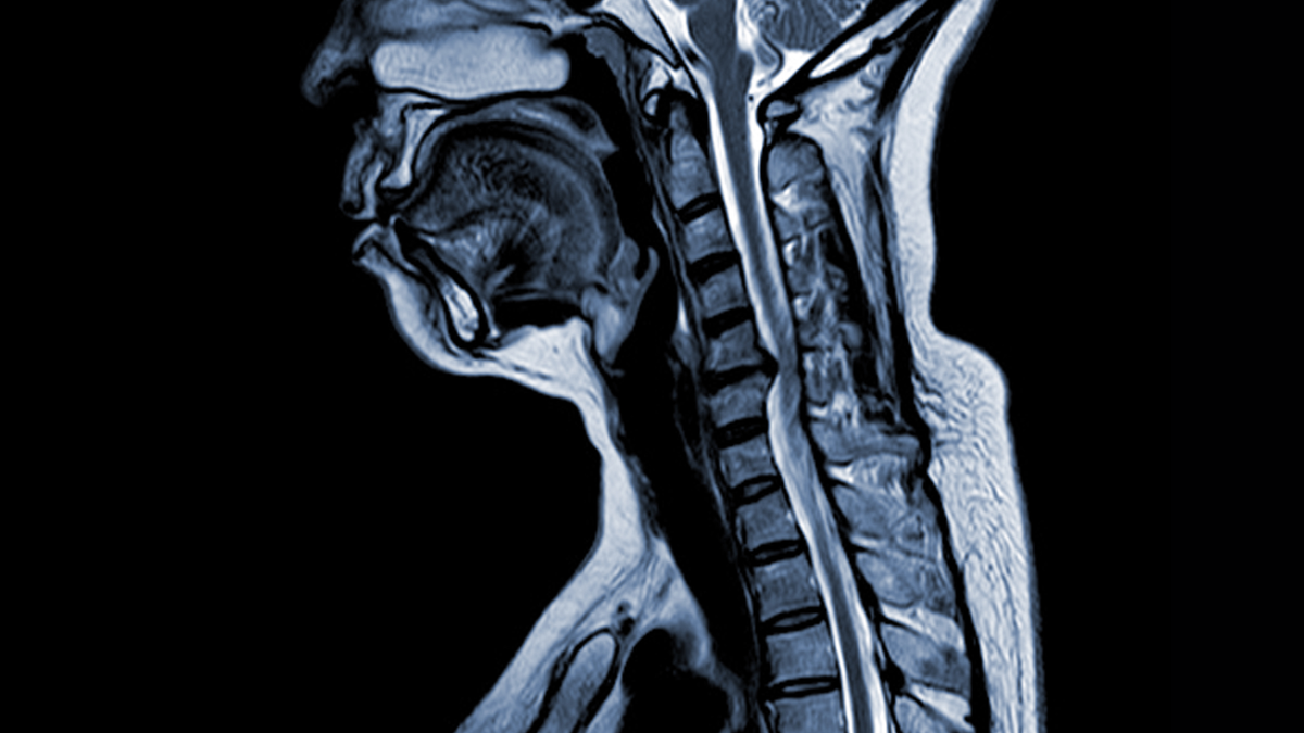 Surgical Timing and Recovery After Cervical Decompression for OPLL
