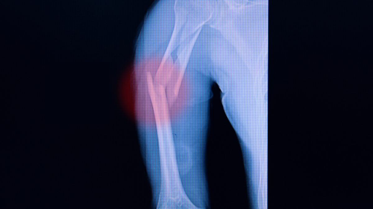 Brace or ORIF for Humeral Shaft Fractures? Go FISH (Again)