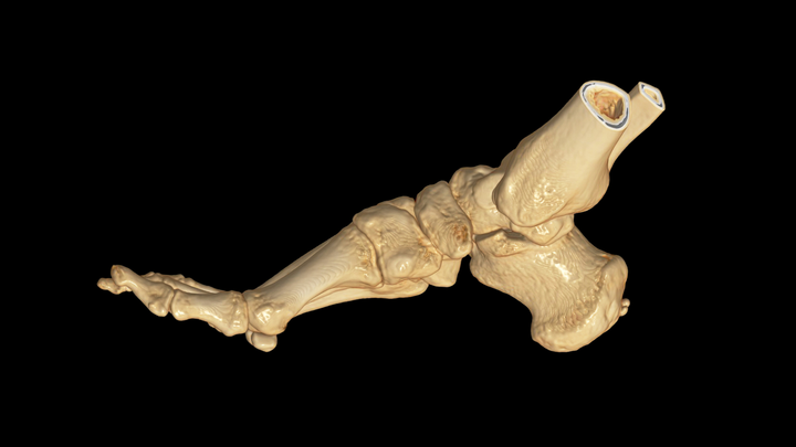 ICYMI: 3D CT to Diagnose Lisfranc Joint Injury