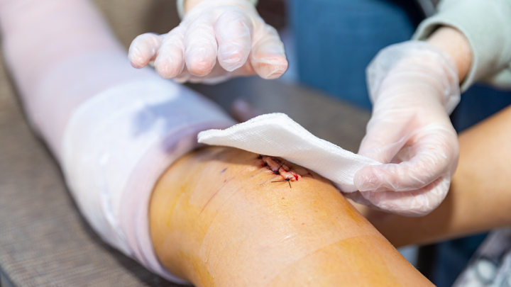 Negative Pressure Wound Therapy for Open Fracture Wounds — Any Port in a Storm?